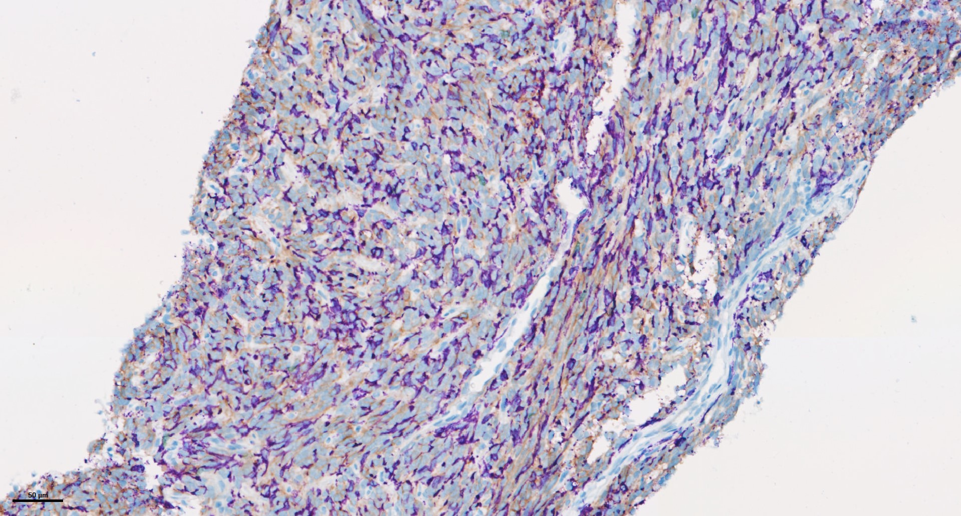Multiplexed-IHC of ovarian cancer in a clinical study combining Trabectedin ans Durvalumab