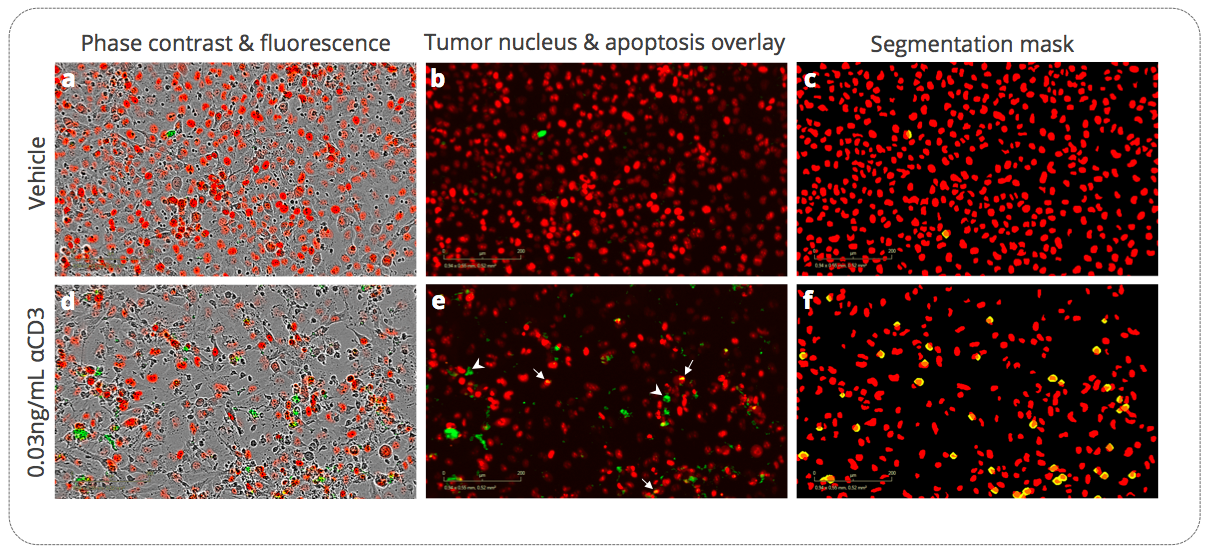 Immune cell-mediated killing of H1299 lung cancer cells in the presence of ?CD3-activated PBMCs. H1299 tumor cells stably expressing a nuclear red fluorescent probe are cultured, at an appropriate effector:target ratio, with inactivated or ?CD3-activated hPBMC. Live cell real time detection images of apoptotic H1299 tumor cells at 72h post-culture with inactivated and ?CD3-activated hPBMC. Tumor cell count (nuclear red probe-expressing cells, (a, b, d, e)) and apoptosis (caspase 3/7 green fluorescent probe, (a, b, d, e)) are kinetically monitored by live cell imaging. Segmentation masks & image analysis are performed (c, f) to quantify apoptosis specifically within the tumor cell population (i.e. caspase 3/7 green fluorescent probe within the nuclear red probe-expressing cells – yellow objects). Arrows in e show apoptotic tumor cells and arrowheads apoptotic non-tumor cells.