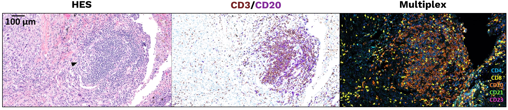 immature TLS detectionby digital-pathology IHC / IF CRO service