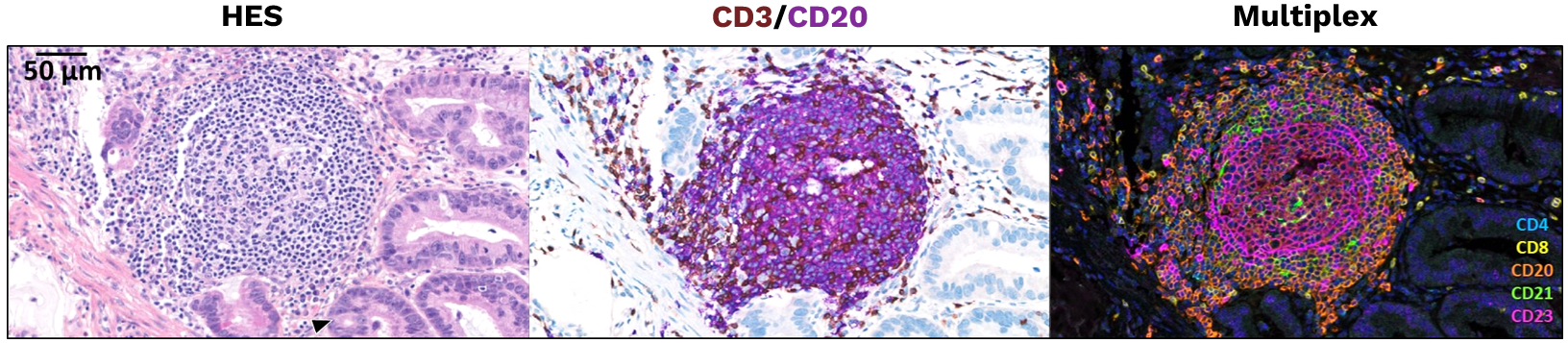 mature TLS scoring by digital imaging IHC IF