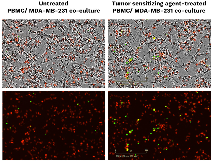 Inhibition of a specific tumor target sensitizes breast MDA-MB-231 tumor cells to immune cell-mediated killing