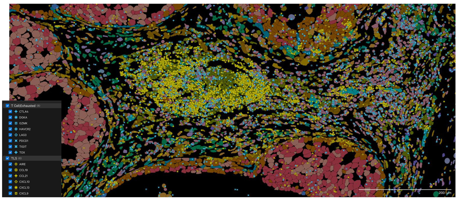 xenium TLS t cell exhaustion breast cancer