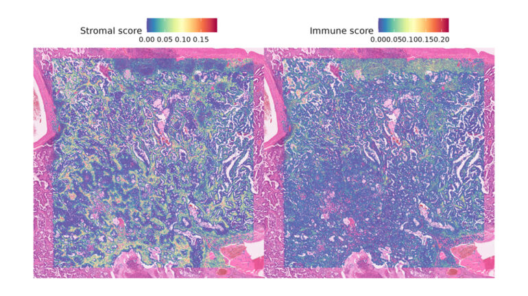 Bioinformatics Analysis of Visium HD Spatial Transcriptomics Datasets Bioinformatics Analysis of Visium HD Spatial Transcriptomics Datasets