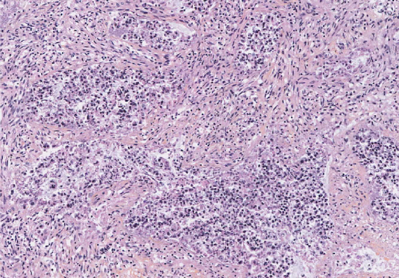Colorectal cancer (CRC) patient-derived tumor fragment (PDTF) after 2 days of anti-CD3 treatment
