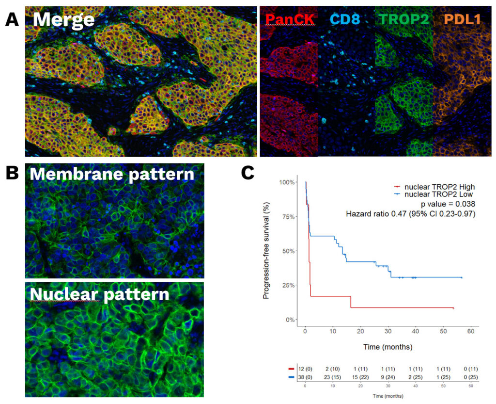Spatial transcriptomics identifies TROP2 as a candidate biomarker of ICI resistance