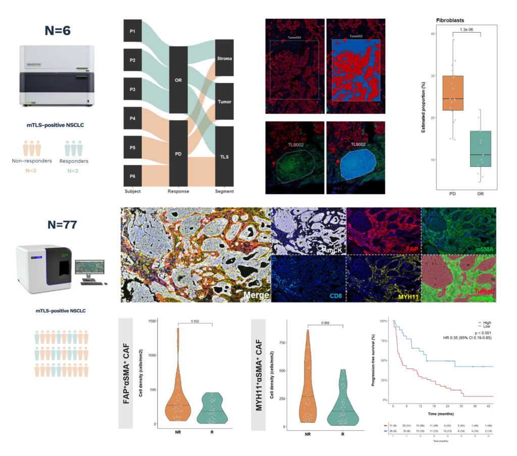 Spatial transcriptomics reveals CAF programs associated with ICI resistance