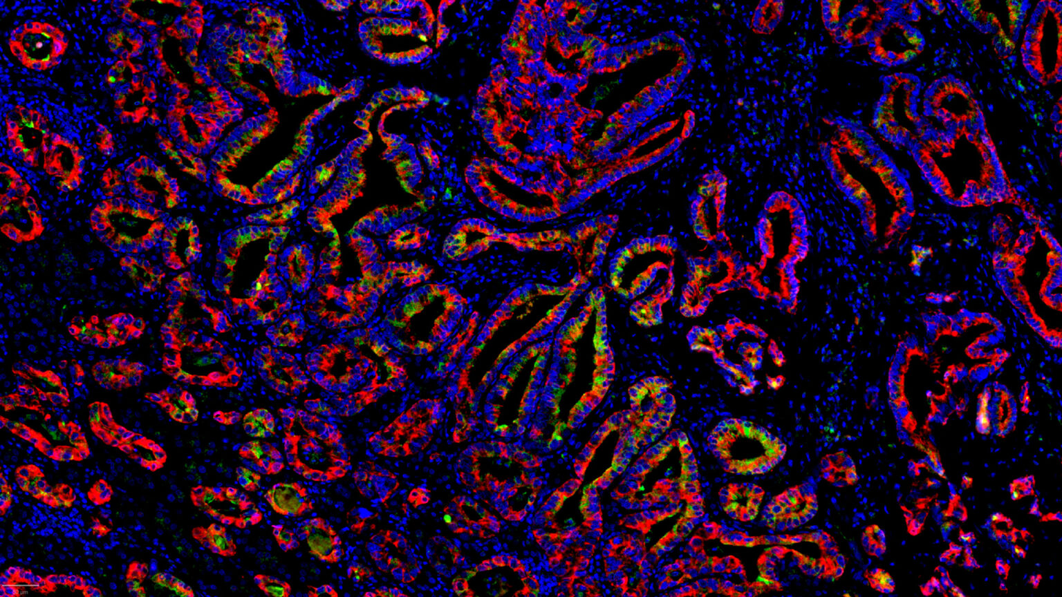 Immunofluorescence staining of oncology target CLDN18.2 (green) in human lung cancer sample (panCK in red)